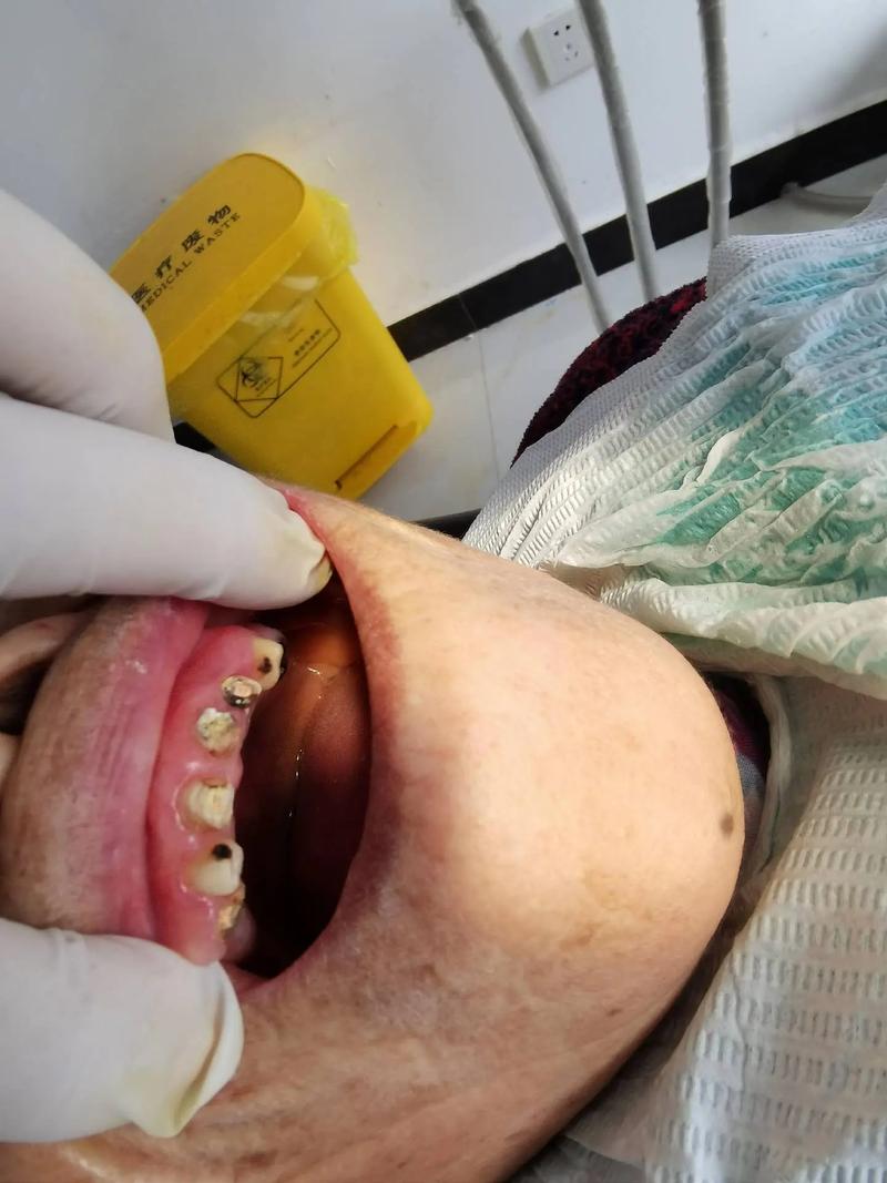 修复牙齿打桩作用